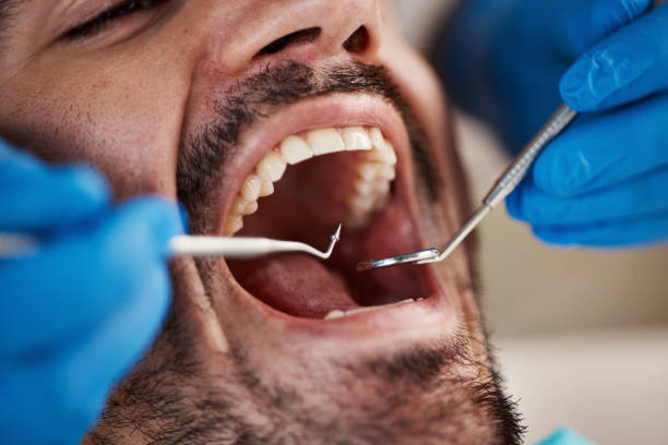 Best Emergency Wisdom Tooth Extraction in Milltown, NJ